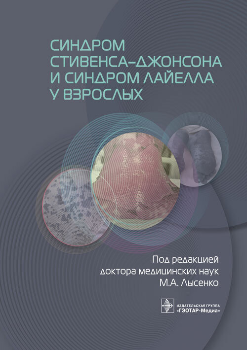 Синдром Стивенса–Джонсона и синдром Лайелла у взрослых